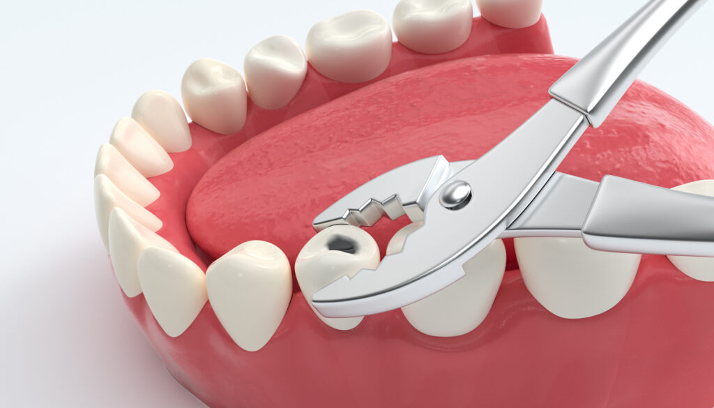 Best Cavity Repair in Oakville