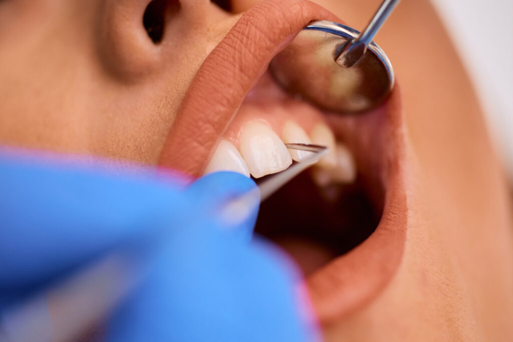 Periodontal Root Planing Scaling