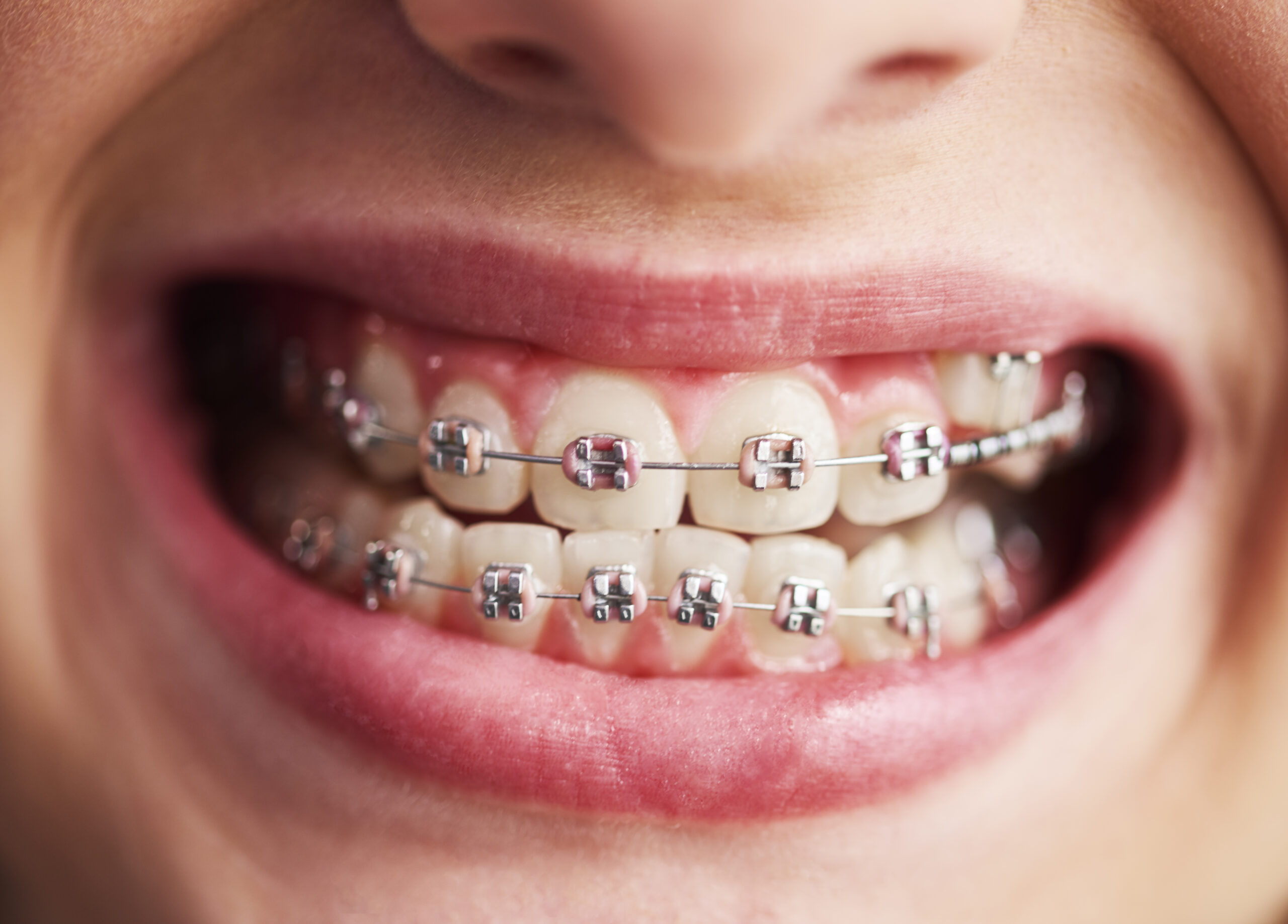 braces in Milton