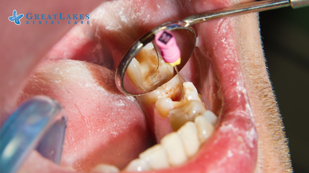 Root Canal in Milton