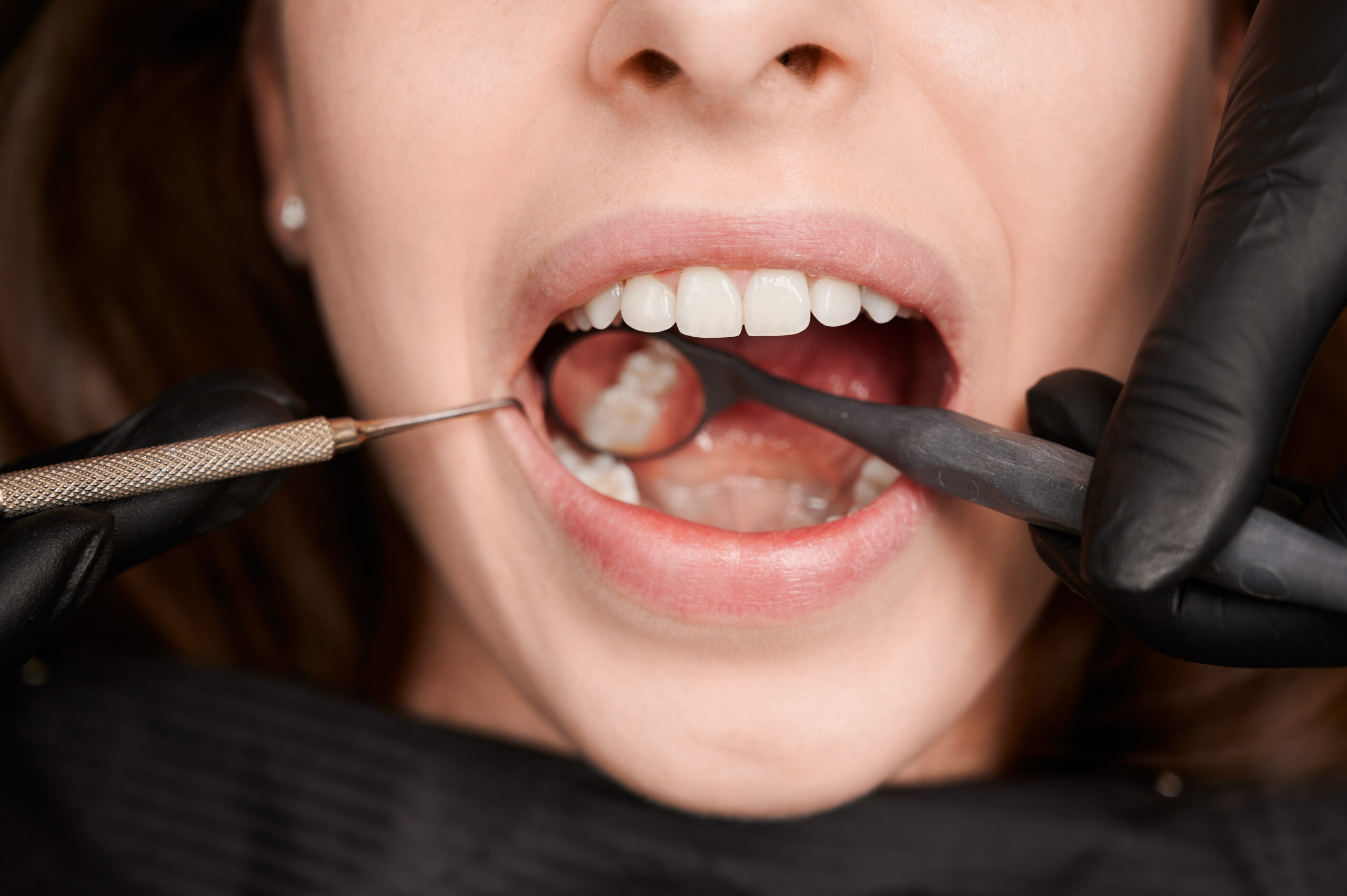 Teeth Fillings in Milton