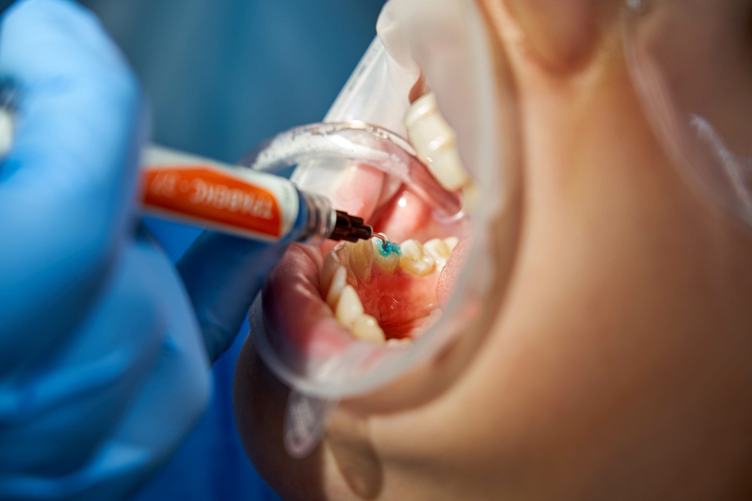 Teeth Cleaning in Oakville